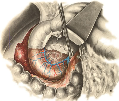 Панкреатодуоденальная резекция. Отслоение корня брыжейки поперечной ободочной кишки и париетальной брюшины от головки поджелудочный железы и нижней горизонтальной части двенадцатиперстной кишки.