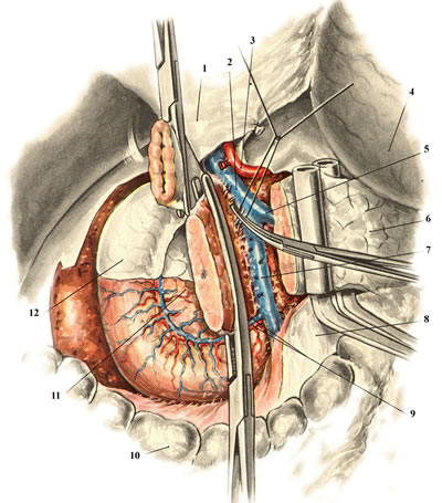 Панкреатодуоденальная резекция. Мобилизация задней поверхности головки поджелудочной железы. Перевязка и пересечение венозных сосудов, идущих к воротной и верхней брыжеечной венам. 1 — lig. hepatoduodenale; 2 — v. portae; 3 — a. hepatica communis; 4 — ventriculus; 5 — v. lienalis; 6 — corpus pancreatis; 7 — v. mesenterica superior; 8 — mesocolon transversum; 9 — a. et v. pancreaticoduodenalis inferior anterior; 10 — colon transversum; 11 — caput pancreatis; 12 — duodenum. 