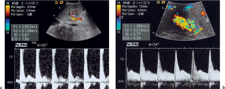Сосудистые осложнения после трансплантации печени. на снимке слева показана допплеровская флуометраия печеночной артерии с высоким индексом сопротивления (Ri). Для сравнения - допплерография с нормальными пиками печеночной артерии