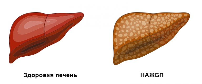 Неалкогольная жировая болезнь печени презентация